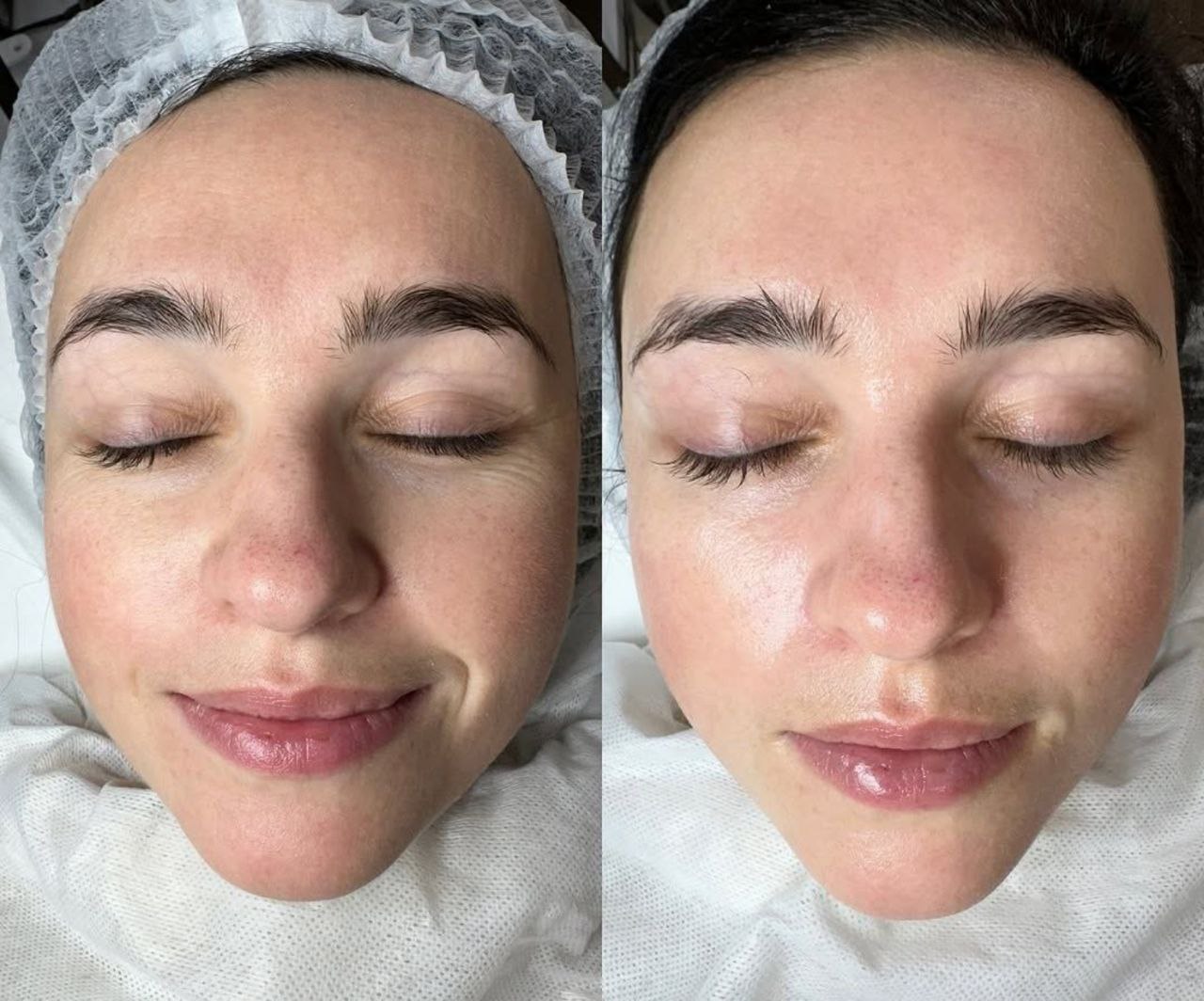 Пример практического применения авторского протокола Intensive Peptide Anti-Age Therapy — Фото № 2