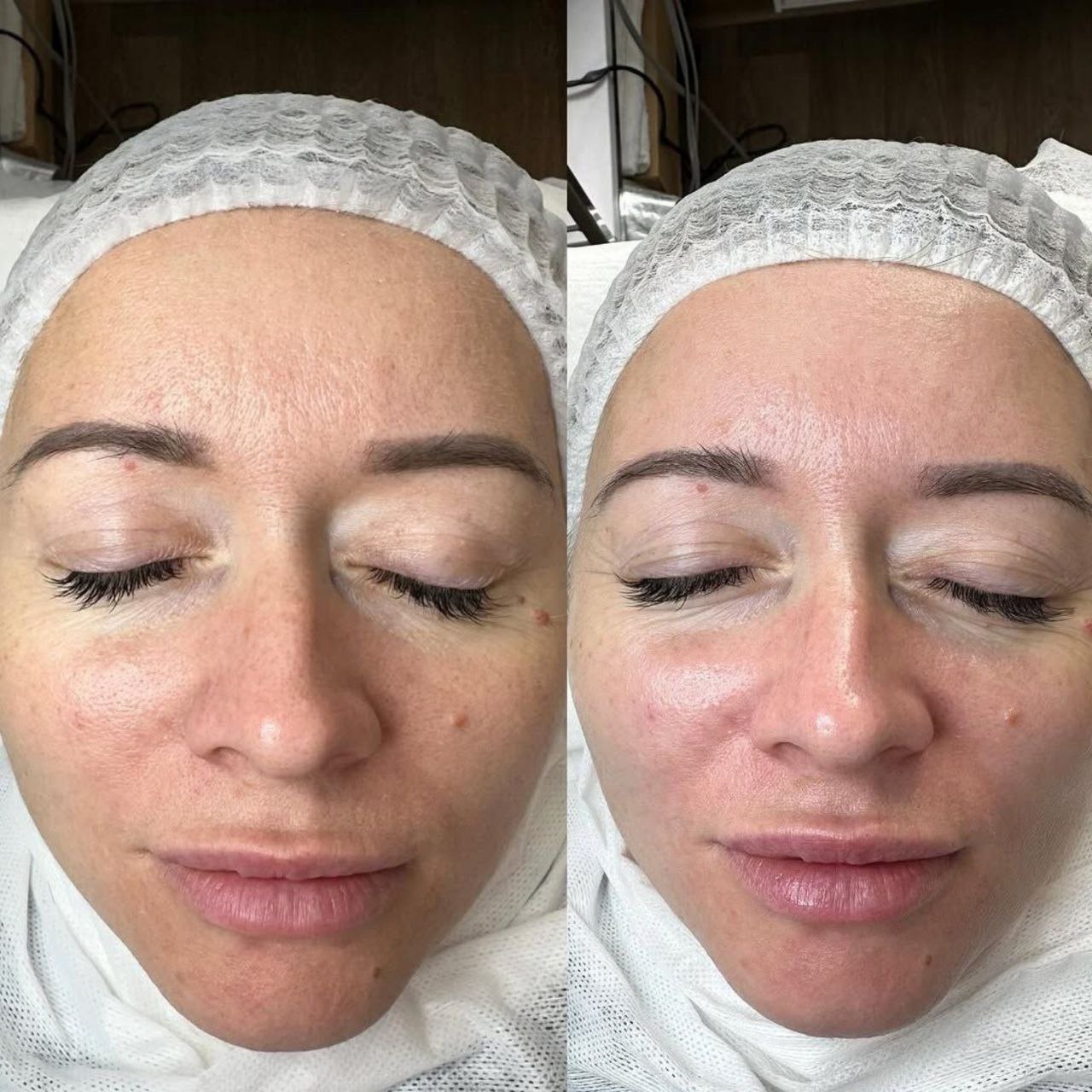 Пример практического применения авторского протокола Intensive Peptide Anti-Age Therapy — Фото № 3