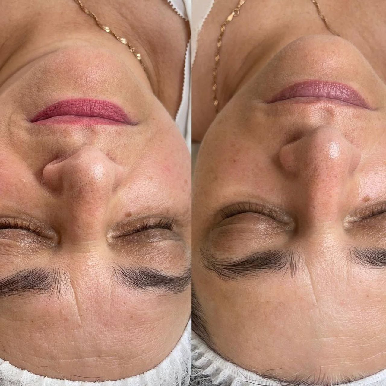 Пример практического применения авторского протокола Intensive Peptide Anti-Age Therapy — Фото № 4