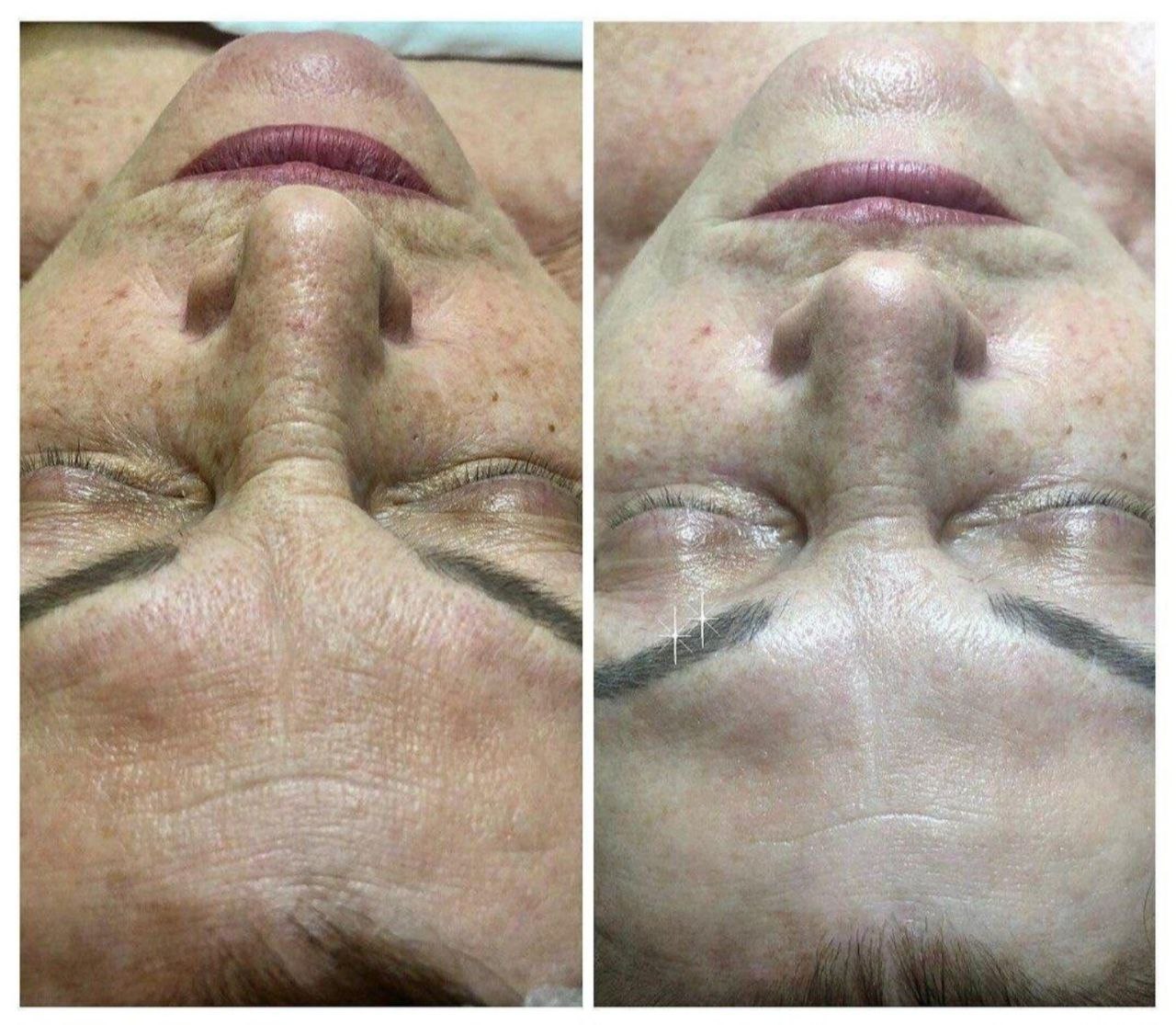 Пример практического применения авторского протокола Intensive Peptide Anti-Age Therapy — Фото № 5