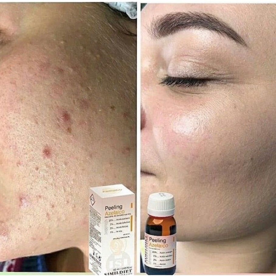 Азелаиновый пилинг Simildiet